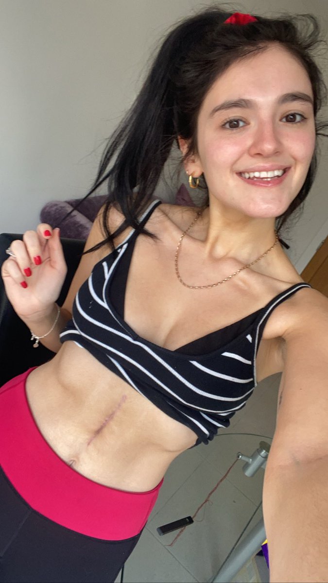 KatieShalka's tweet photo. Thank you to my fiancée @_megangardiner , my amazing family, friends and strangers who have supported me all the way through this journey, to you I will always be eternally grateful. ( so many more people I can’t tag but I love you all)Xxxx
#nutcrackersyndrome #lrvt #recovery https://t.co/xLoHzoxIKN