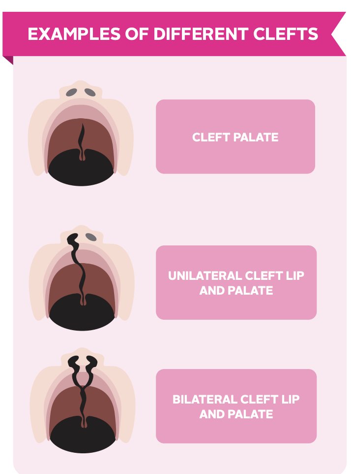 RCSLTpolicy's tweet photo. Our new #cleft lip & #palate factsheet highlights the different types of cleft. Read more, including on the role of #CleftSLT here: https://t.co/f48Pe8KprJ #BehindEverySmile https://t.co/MznY9RCPhm