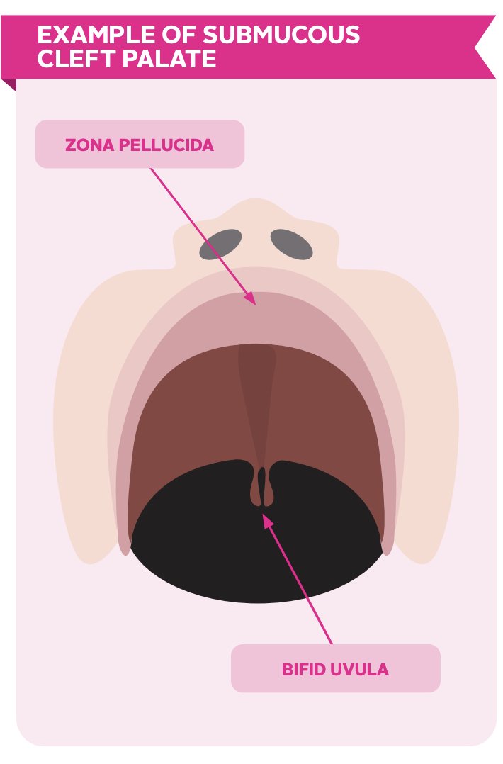 RCSLTpolicy's tweet photo. Our #cleft lip & #palate factsheet also includes an illustration of #submucous cleft palate. For more including on #CleftSLT download the factsheet here: https://t.co/f48Pe8KprJ #BehindEverySmile https://t.co/irN9izjCK1