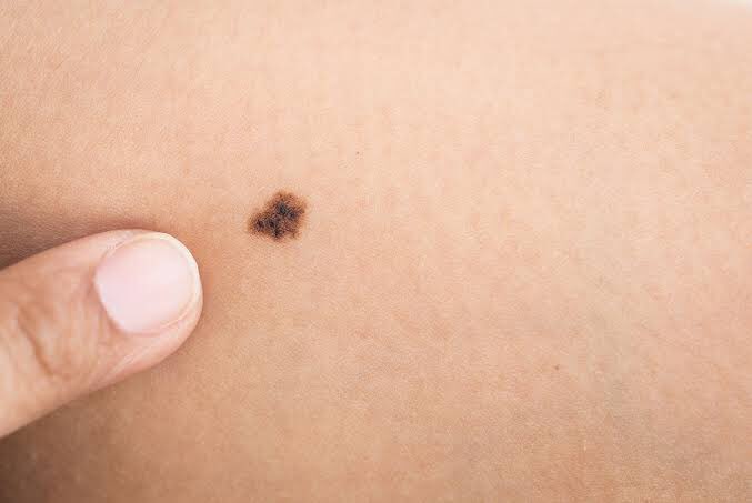 Spotscreen's tweet image. It is estimated that 15,691 new cases of melanoma in Australia will be diagnosed for 2020.

With COVID-19 still impacting our every day lives with many of us being separated from one another, we can still spread the word and share the facts of skin cancer to help save lives 🧴 ☀️