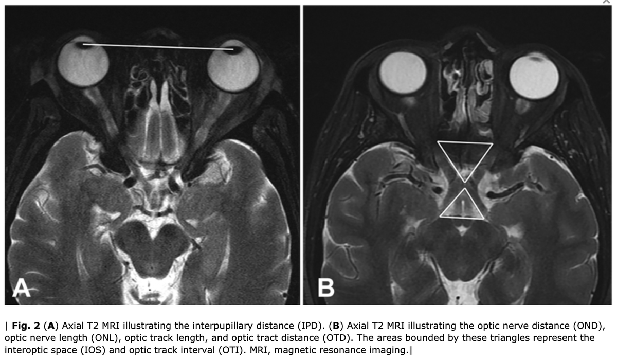graffeo's tweet photo. #JNLSB_Online Anatomical Predictors of Transcranial Surgical Access to the Suprasellar Space #nsgy #ent #eea #neuroanatomy #skullbase #approaches #opticchiasm #suprasellar #prefixed https://t.co/w9w5Ykro1O https://t.co/xzqtmZo4VX