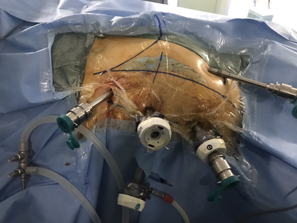 Dr Mahesh Desai (@drmaheshdesai4) on Twitter photo Simultaneous right robotic nephrectomy and robotic left adrenalectomy (solitary metastasis) . IMDC -low risk . Plan to add TKI with PDL1 inhibitor. Have done two such cases lap- third one robotic.Any critic??<a href="/DrMihirDesai/">Mihir Desai</a> <a href="/pprao/">Pradeep Rao</a> <a href="/DrGaganGautam/">Gagan Gautam</a> <a href="/abhisingh82/">Abhishek singh</a> Simultaneous right robotic nephrectomy and robotic left adrenalectomy (solitary metastasis) . IMDC -low risk . Plan to add TKI with PDL1 inhibitor. Have done two such cases lap- third one robotic.Any critic??<a href="/DrMihirDesai/">Mihir Desai</a> <a href="/pprao/">Pradeep Rao</a> <a href="/DrGaganGautam/">Gagan Gautam</a> <a href="/abhisingh82/">Abhishek singh</a>