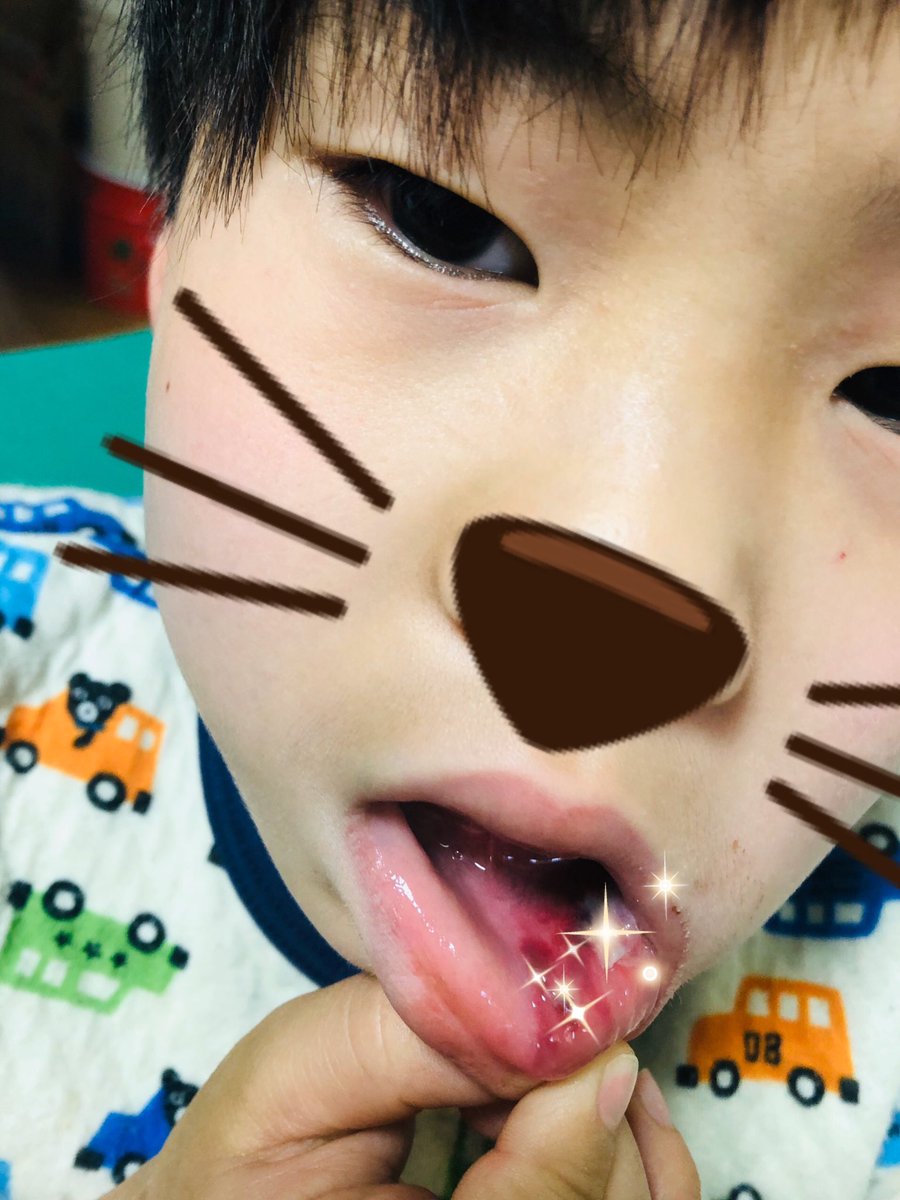 マナティฅ ﻌ ฅ On Twitter 今朝も痛くて 唇がフグ田君 顎も腫れてるから 消防に行って病院聞いて行ったけど いっぱいだからと断られ 明日から5連勤で病院行けないけど仕方無し 治れ 自然治癒 怪我 唇フグ田くん 消防署 自然治癒