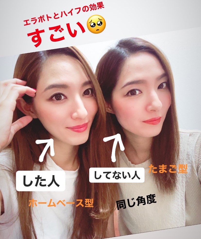 カナ على تويتر 元の顔の形が違うから正面やと分かりづらいけどエラ意識した角度で撮ったら一目瞭然でした カナ على تويتر 元の顔の形が違うから正面やと分かりづらいけどエラ意識した角度で撮ったら一目瞭然でした