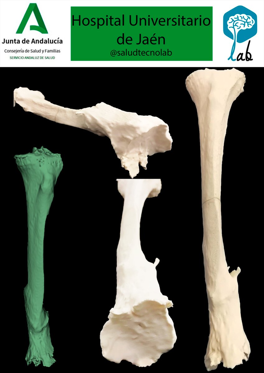 saludtecnolab's tweet photo. #Traumatology #3dcot #Orthopaedic #Tibial #jaen @HospitaldeJaen #cursocot #3Dmodel
#model3D #3Dprinting #3Dprinted @3DSlicerApp
 #slicer3D https://t.co/p0aWkusmLt
