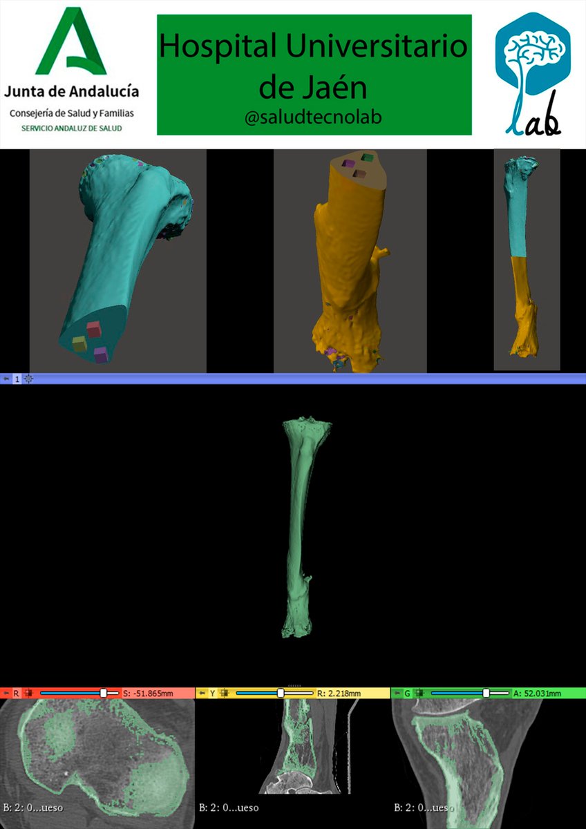 saludtecnolab's tweet photo. #Traumatology #3dcot #Orthopaedic #Tibial #jaen @HospitaldeJaen #cursocot #3Dmodel #model3D #3Dprinting #3Dprinted @3DSlicerApp  #slicer3D https://t.co/KTPtvLr03a