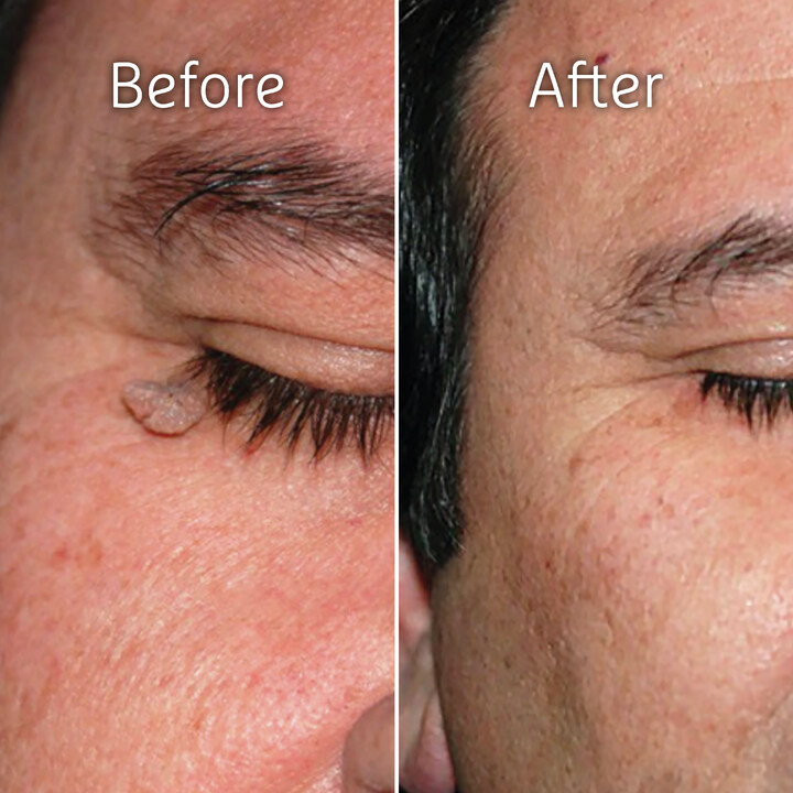 freezpen's tweet image. Look at the efficiency of #Freezpen! In just few weeks after treatment the skin lesion is removed, try it for yourself! ✍️

➡️ freezpen.com