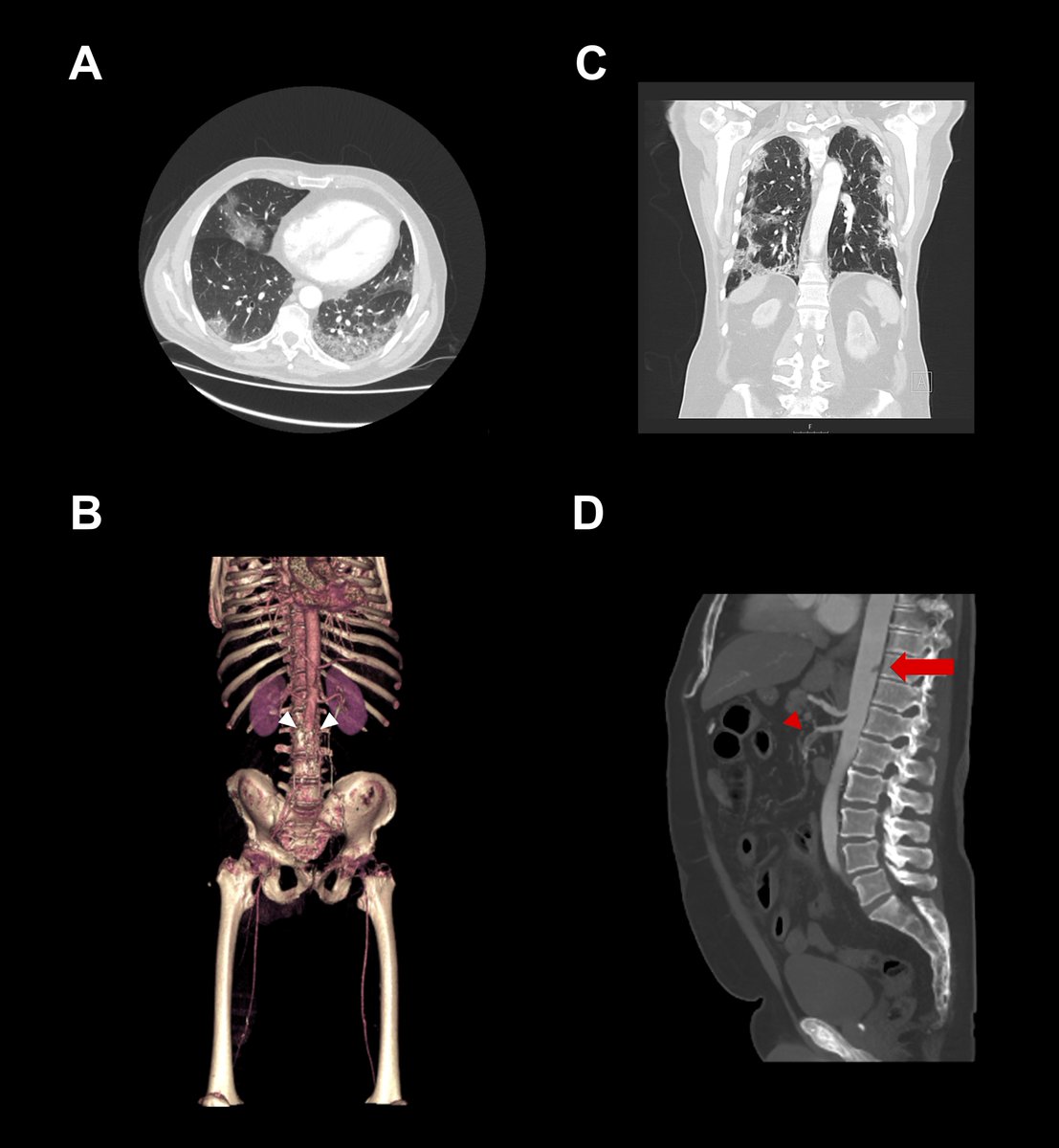 Paul Vulliamy (@paulvulliamy) on Twitter photo Our report of major arterial thrombosis as presenting features of #COVID19 is out in British J Haematology onlinelibrary.wiley.com/doi/epdf/10.11…
<a href="/BritSocHaem/">BSH - Haematology</a> @ThromboCOVID
A small addition to the growing evidence of #thrombosis in SARS-CoV-2 infection Our report of major arterial thrombosis as presenting features of #COVID19 is out in British J Haematology onlinelibrary.wiley.com/doi/epdf/10.11…
<a href="/BritSocHaem/">BSH - Haematology</a> @ThromboCOVID
A small addition to the growing evidence of #thrombosis in SARS-CoV-2 infection