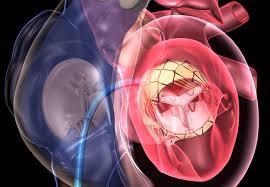 #Transcatheter #Mitral #Valve #Replacement #Market Insights and Applications 2020-2026 | Sample Report @ bit.ly/35ugyYl

Key Players: <a href="/abbottglobal/">Abbott</a> <a href="/EdwardsLifesci/">Edwards Lifesciences</a> <a href="/microintervent/">Micro Interventional</a> @Neovasc  <a href="/MitrAssist/">bonnie</a> , NaviGate Cardiac Structures <a href="/Valtech/">valtech_</a>