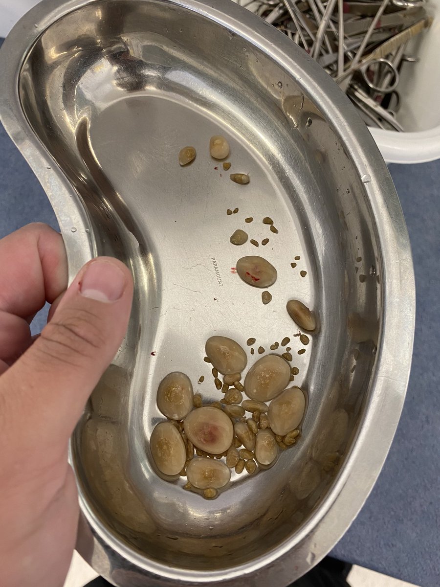 lwescott's tweet photo. My Cystotomy went really well, we took out nearly 100 uroliths (bladder stones) which will go to the lab for analysis, she went out for a pee this afternoon and has just gone home tail wagging 🐶 #FirstVetJob
[owner gave photo consent] https://t.co/NxqL95lekk