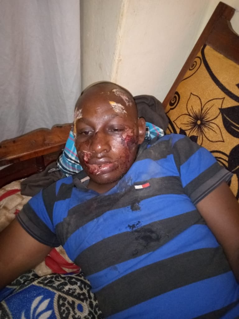 StandardKenya's tweet photo. UPDATE: This gentleman was allegedly attacked by police officers while going to take his sick mother to hospital at Muthingiini location, Kambu, Kibwezi East sub-county. 
All the money he had was taken, and he was left lying on the roadside

#Enforcingcurfew #Policebrutality https://t.co/M0iIQ9gpdt