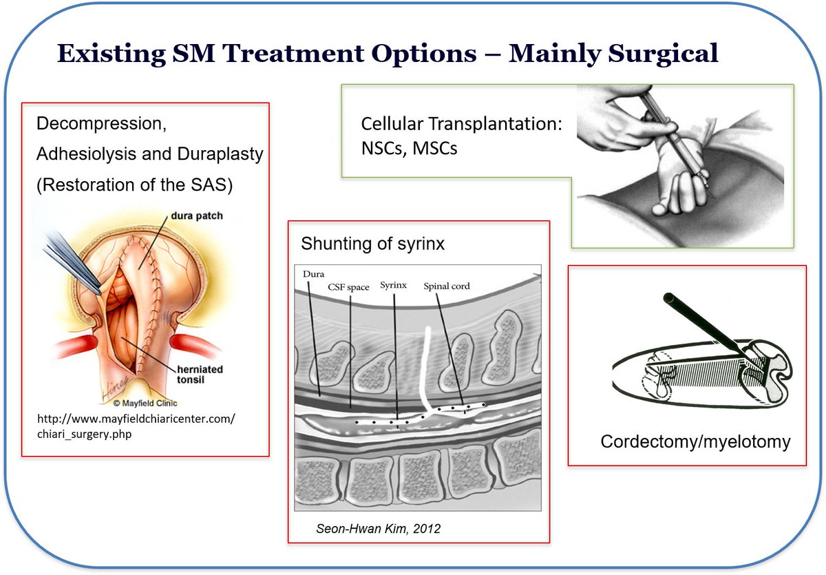 DipakPukale's tweet photo. Day 4: #Syringomyelia Awareness Month!
How is it treated? - Surgery is usually recommended for individuals with symptomatic or progressive SM. There are two general forms of treatment: restoration of normal #CSFflow around the spinal cord, and direct drainage of the syrinx. https://t.co/uvtw7jpKtv