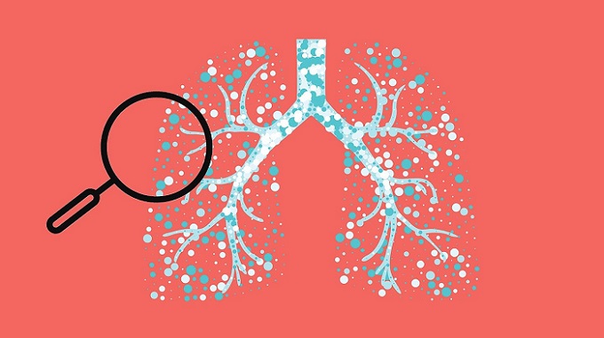 Chronicmeet's tweet photo. Experimental studies showed that iron build-up in the lungs triggered the immune system typical in asthma and increased the severity of the disease - https://t.co/qyUstBLzLL

#WorldAsthmaDay #Asthma #COVID19 #lungdiseases #research https://t.co/P4Pe4Rm0kH