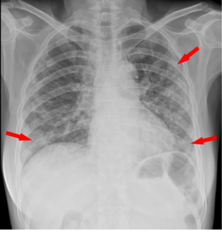 снимок чистых легких. легкие больного коронавирусом. рентген при вирусной пневмонии. пораженные легкие от коронавируса снимок кт. легкие после ковида.