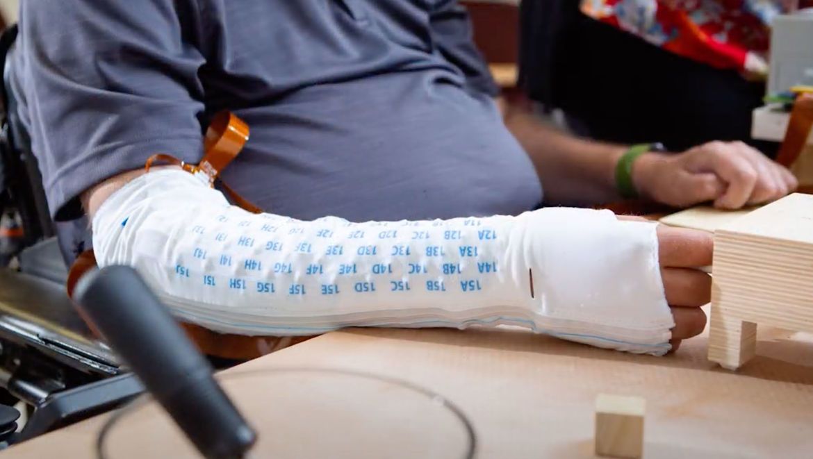 Neil_Nand's tweet photo. The ability to have someone wit ha spinal cord injury move their hand again is real! Even the ability to feel has been restored.

https://t.co/vwy23fZlVL https://t.co/8IIy5SS9x0