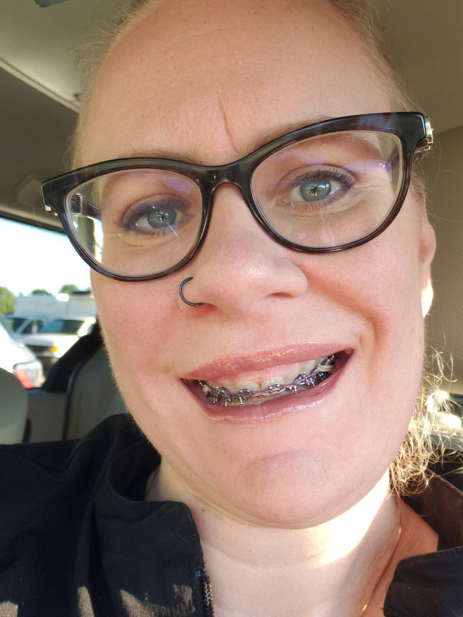 One year down.  One year to go.  Rocking these #adultbraces