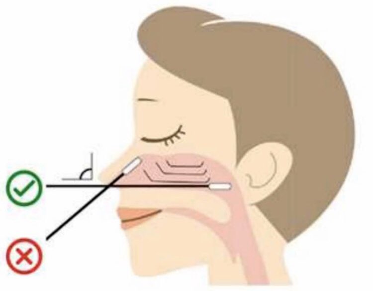 FXMoronval's tweet image. ⚠️ Plusieurs reportages TV montrent des prélèvements de tests mal réalisés (donc à risque d’être faussement négatif). Le prélèvement doit s’effectuer parallèlement au palais et s’enfoncer profondément pour être naso-pharyngé ! 
Voici comment le faire (avec le sourire 😅) ⬇️
