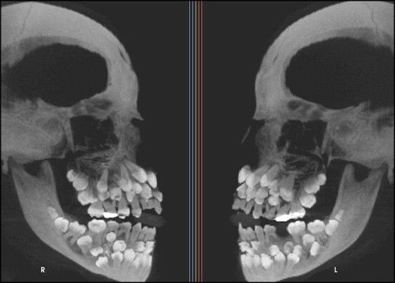 evrimagaci's tweet photo. Hiperdonti, normalden fazla sayıda diş üretmeye sebep olan bir hastalıktır.

Burada, 11.5 yaşındaki bir çocukta rastlanan, 81 adet diş oluşumuna sebep olan bir hiperdonti vakasına yönelik X Işını taraması sonucu görülmektedir. https://t.co/sGdPqOxGo4