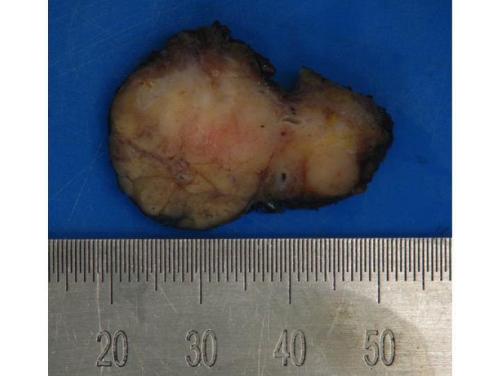 GuptaRuta's tweet photo. More salivary gland: Firm enlarging  submandibular gland mass ?ca. 
Lobular architecture maintained. Dense lymphoid infiltrate. Several plasma cells: Histologic features of IgG4 related sclerosing disease #TissuePathologyRPA @SameeraAnsar2 @ProsserNj https://t.co/G4Mi91Srfv