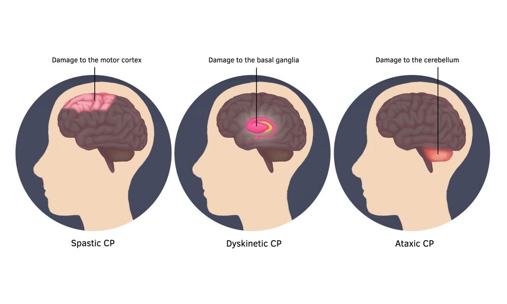INVEION1's tweet photo. Children with Cerebral Palsy are likely to also have other impairments in addition to their motor disability.  There are four main types of CP that include spastic CP, Dyskinetic CP, Ataxic CP and mixed or combined CP. #cerebralpalsy #rehabilitation #therapy #INVEION https://t.co/LjoZ67uvi6
