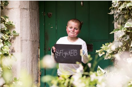 #FightEB hero! 11 year old Mason will be taking on his own lockdown challenges to raise funds for DEBRA UK <a href="/CharityDEBRA/">DEBRA UK</a> Mason has Recessive Dystrophic Epidermolysis Bullosa (EB) &amp; endures pain, needing around the clock care. Read on &amp; please donate here: justgiving.com/fundraising/ke…