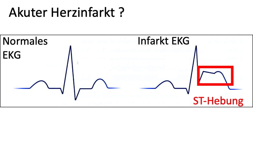 VonProf's tweet photo. Eine mögliche Erklärung für die infarkttypischen #EKG-Veränderungen ist, dass das Virus über den #ACE2-Rezeptor an der Gefässinnenhaut zum Lostreten einer komplexen Entzündungsreaktion führt aus der letztendlich eine Durchblutungsstörung am Herzen resultiert. https://t.co/H0kZDKokcQ