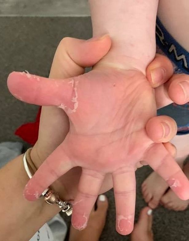 HandtevyMD's tweet photo. #COVID manifesting as Kawasaki Disease isn't a new phenomenon.  This paper in 2005 described a similar pattern in children infected with HCoV-NH.  Dx and treatment within 5-10 days is imperative to avoid the cardiac sequelae of the disease.  Full link: https://t.co/3WczhqMSJY https://t.co/lHgLXkePav