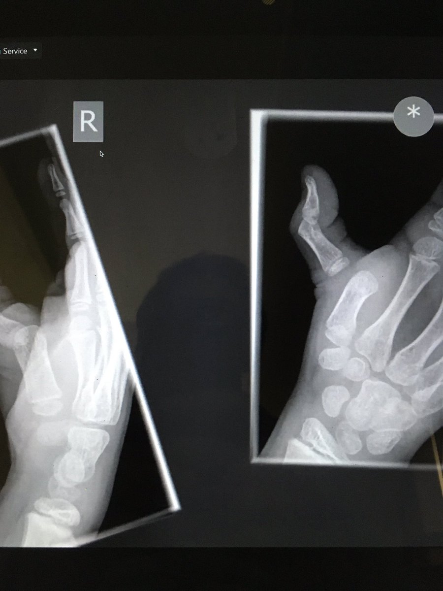 Lisa_Newington's tweet photo. Fantastic online hand radiology teaching! Thank you @handprocedures!! 🙏 And lovely to see so many #handtherapy pals. 👋 https://t.co/5S7SG1ZkO3