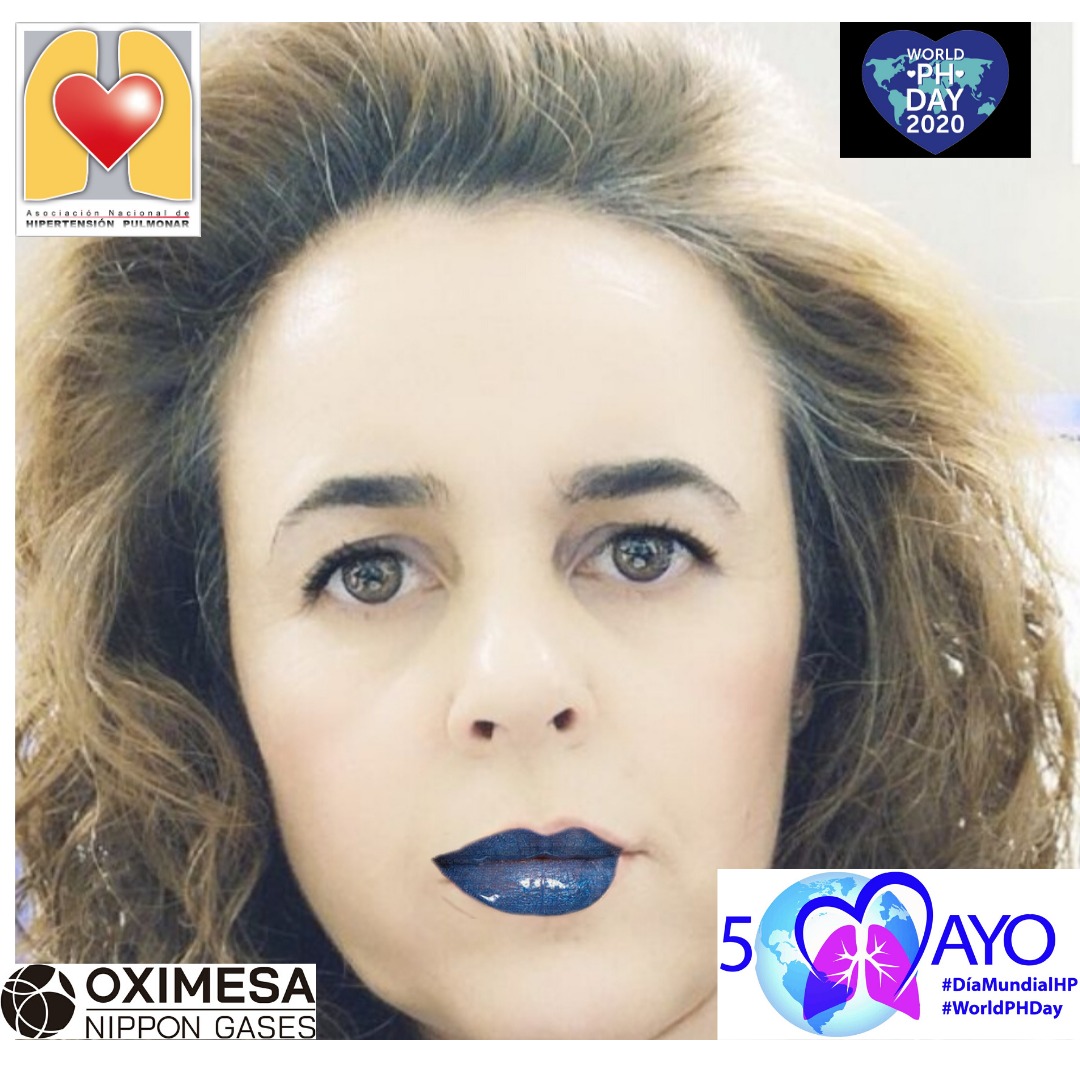 ANdHP's tweet photo. Más personas se unen a la causa! Muchas gracias por poner voz a las personas con #HipertensionPulmonar #DMHipertensionPulmonar #WorldPHDay #WorldPHDay2020 #LabiosAzules #bluelips #pheurope @OximesaNG https://t.co/ny4pmqCGuM