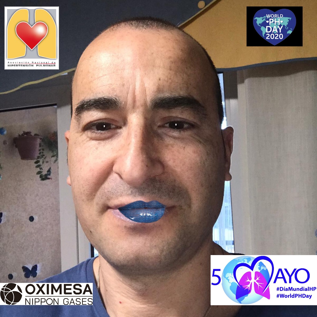 ANdHP's tweet photo. Más personas se unen a la causa! Muchas gracias por poner voz a las personas con #HipertensionPulmonar #DMHipertensionPulmonar #WorldPHDay #WorldPHDay2020 #LabiosAzules #bluelips #pheurope @OximesaNG https://t.co/ny4pmqCGuM