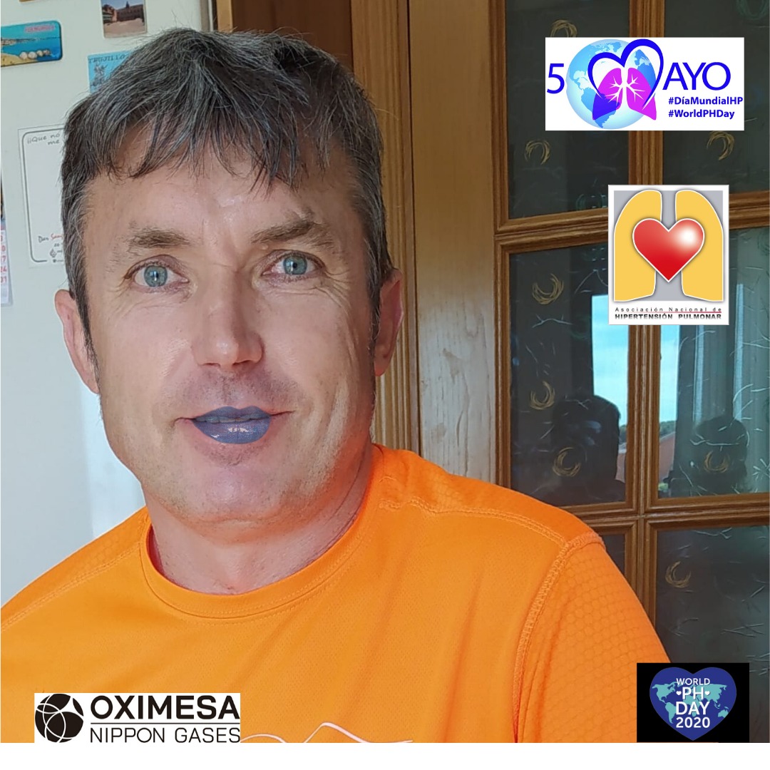 ANdHP's tweet photo. La cianosis, que se te pongan los #LabiosAzules #bluelips es uno de los #síntomas de la #HipertensionPulmonar por ello te animamos a pintarte los labios y a subir la foto hoy que es el #DMHipertensionPulmonar #WorldPHDay #WorldPHDay2020 #pheurope @OximesaNG https://t.co/QFqAzyRpXV