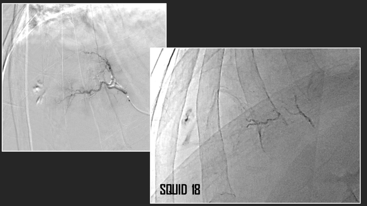 AAlonsoBurgos's tweet photo. Little by little into our previous life... 

I use liquid embolics (SquidPeri18 @BaltSpain) in bleeding becasuse 1) I´m (very) used to. 2)Liquids have lower recanalization rates than coils/amplatzer in a massive bleeding. What would you have done?

#interventionalradiology #MIIP https://t.co/foEB5HGEgE