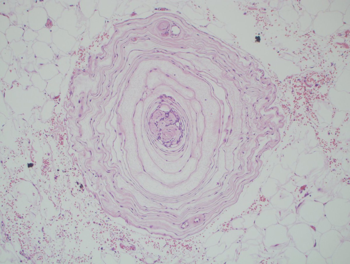 Pacinian Cor Pacinian Corpuscle Slide Tree Of Vater–Pacinian Corpuscles In The