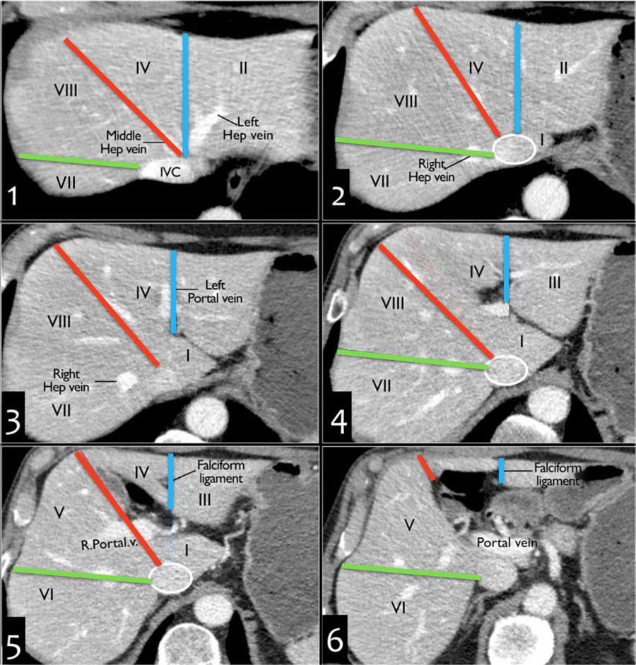 How to separate liver segments on cross sectional imagingLeft lobe: lateral(II/III) vs medial segment (IVA/B)Extrapolate a line along the falciform ligament superiorly to the confluence of the left and middle hepatic veins at the IVC (blue line) #SoMe4IQLatAm  #SoMe4Surgery