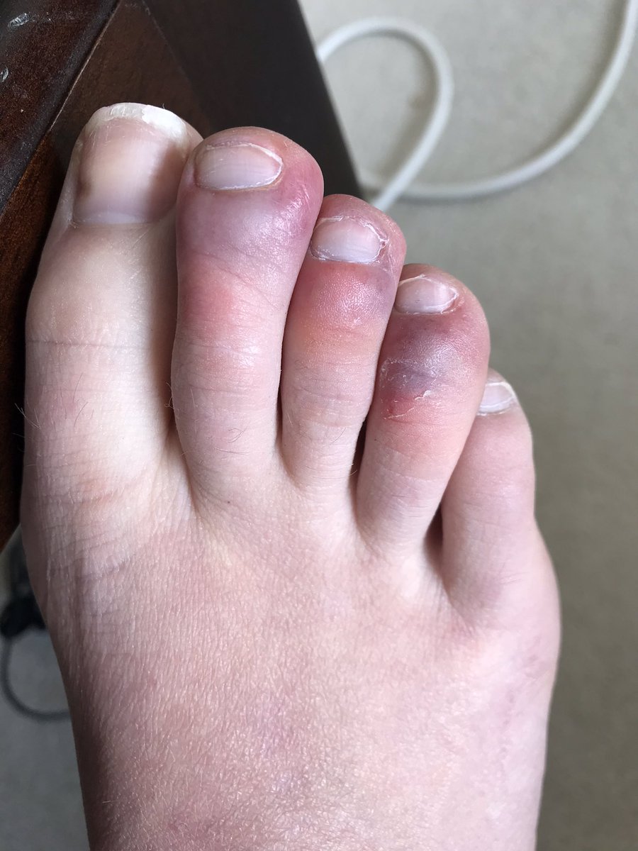 Jordan24255152's tweet photo. Was diagnosed with #covidtoes today by a doctor, after having these swollen and itchy toes for about 2 weeks now. No other symptoms apart from feeling more tired than usual and having a sore throat with fatigue for a couple days last week! https://t.co/tkWuw8BnQz