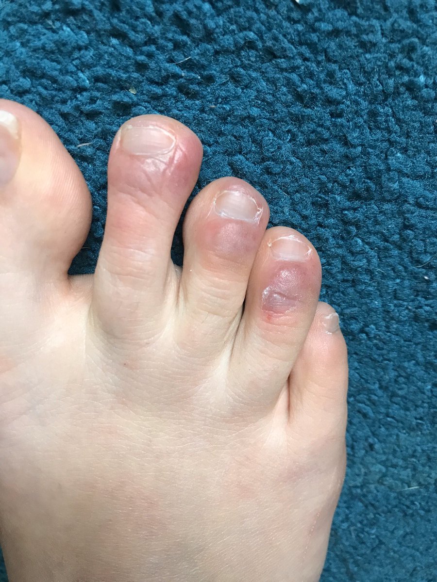 Jordan24255152's tweet photo. Was diagnosed with #covidtoes today by a doctor, after having these swollen and itchy toes for about 2 weeks now. No other symptoms apart from feeling more tired than usual and having a sore throat with fatigue for a couple days last week! https://t.co/tkWuw8BnQz