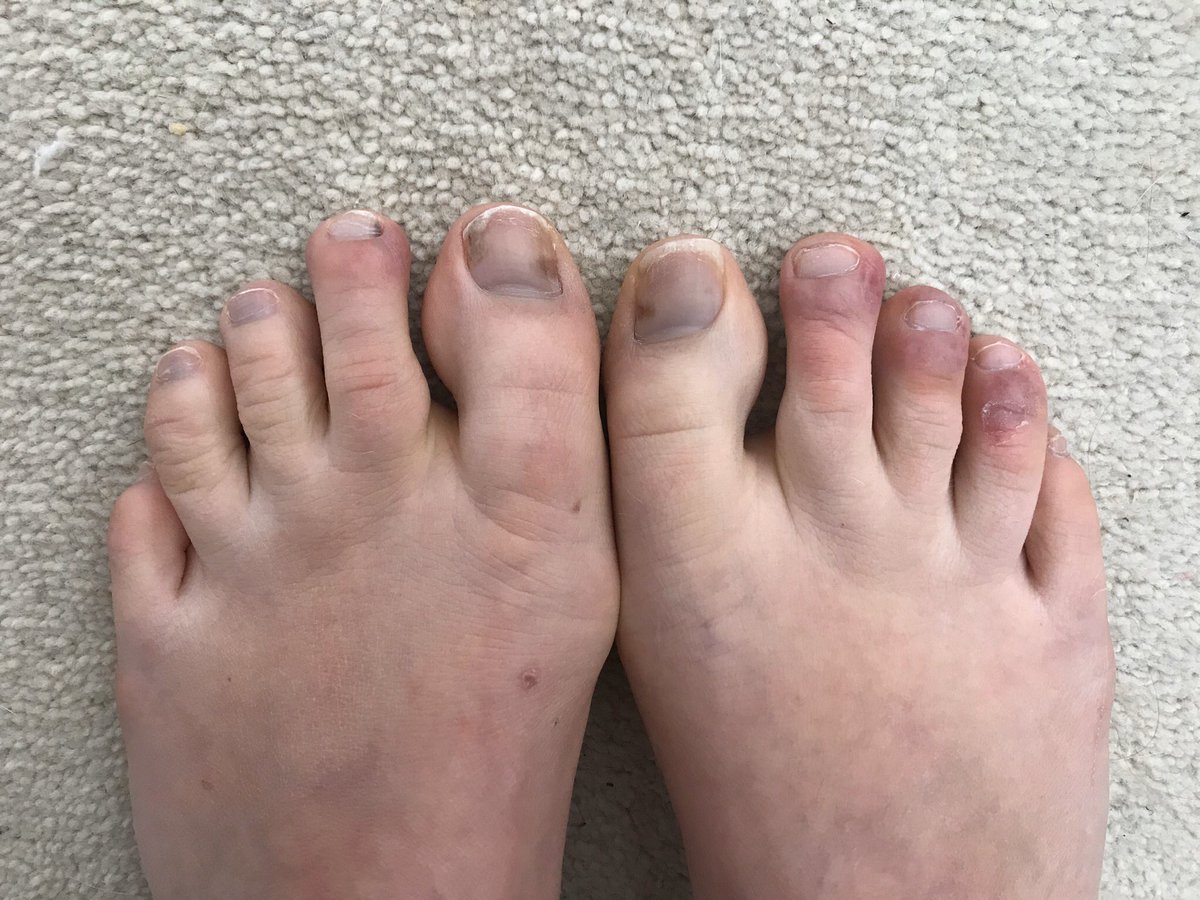 Jordan24255152's tweet photo. Was diagnosed with #covidtoes today by a doctor, after having these swollen and itchy toes for about 2 weeks now. No other symptoms apart from feeling more tired than usual and having a sore throat with fatigue for a couple days last week! https://t.co/tkWuw8BnQz