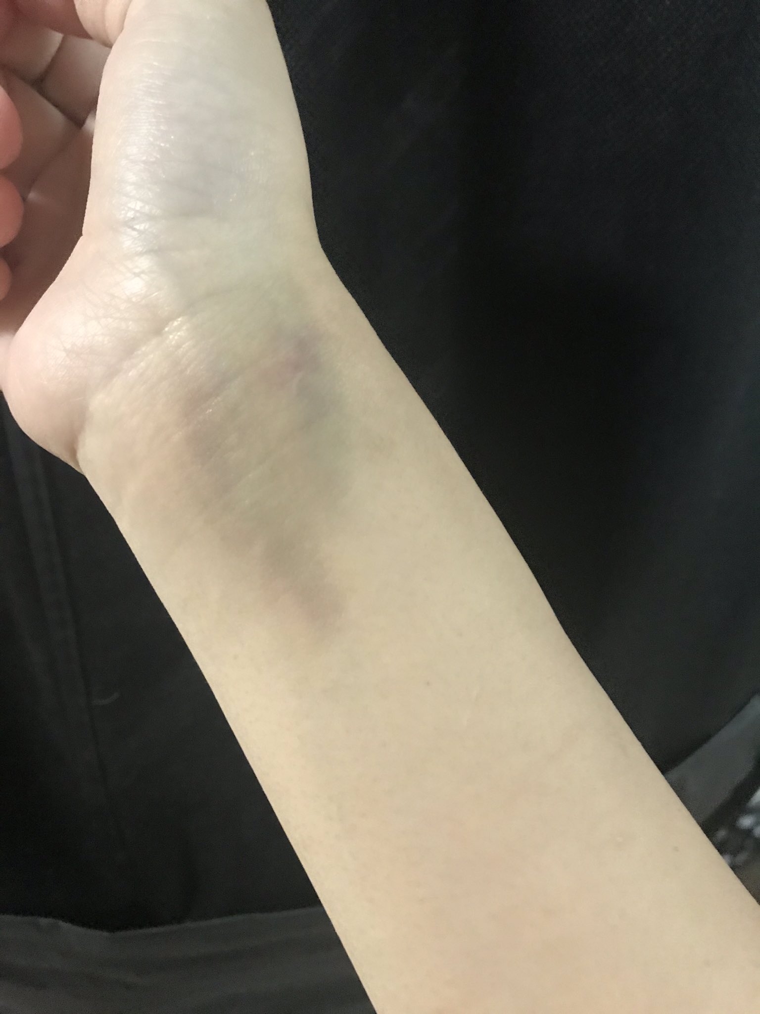 みー バイク便エキゾハウスずーとぴあ中の人 おはようございます 転んだところがアザになりました笑 気がついたらものすごく痛くなってきた ちなみにこれのこと 青タン っていう人いますか それとも 青痣 アザ 青なじみ 方言 って色々あって