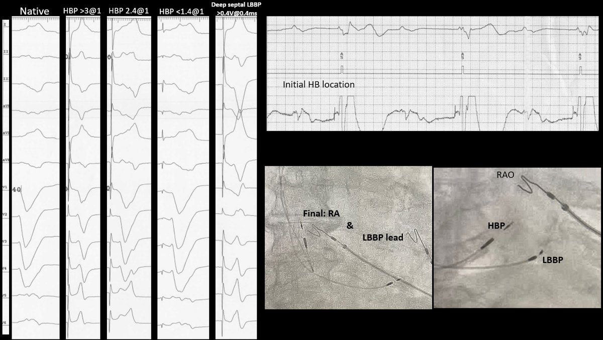 nickkotch's tweet photo. Back in the lab: Elderly pt w/ 2:1 & CHB, LBBB. Nice initial His location though ⬆️LBBB recruitment threshold. Went to deep septum location —> great threshold w/ septal/LBBP #Epeeps #SorryHis #ConductionPacing #cardiotwitter https://t.co/vZ9fguO0SU