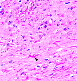 YoussefK_MD's tweet photo. What is the non-neoplastic process where you would find these nice structures in the CNS?
#OnePathBoardPointAtATime
#Neuropathology https://t.co/975J355xun