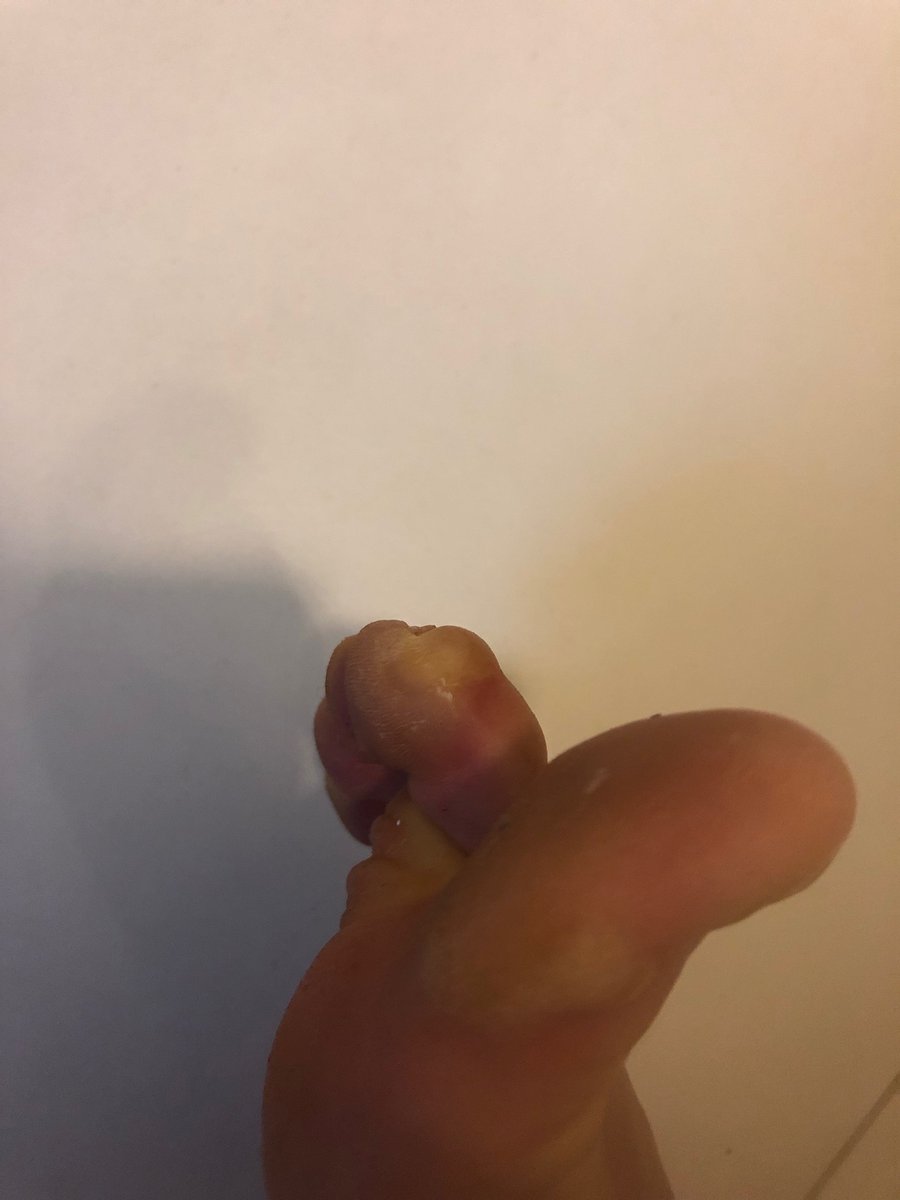 WildKinesiology's tweet photo. #vegansavertyoureyes
#trailrunnerproblems 

Should I:

A) pop it
B) don’t pop it https://t.co/xCLswbptiH