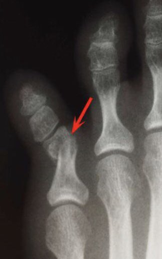 Перелом дистального эпифиза основной фаланги 4 пальца. Перелом основания проксимальной фаланги 5 пальца без смещения. Оскольчатый перелом фаланги пальца руки. Стрессовый перелом плюсневой кости. Перелом мизинца стопы рентген.