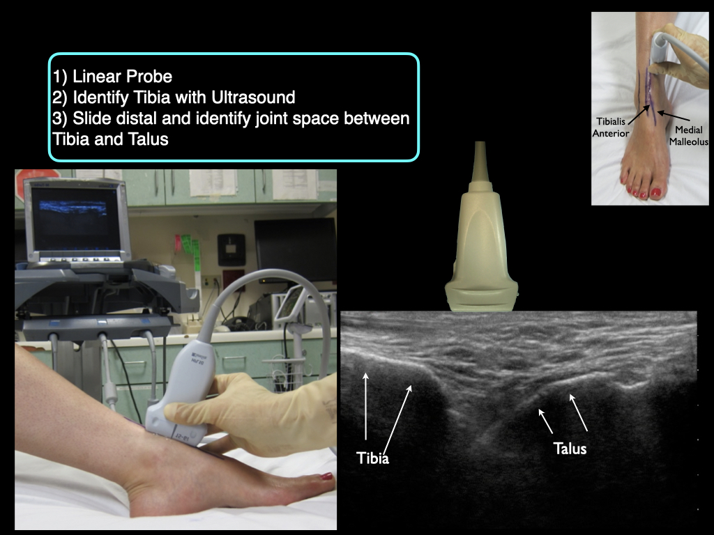 Cellulitis or underlying infection? 
POCUS = ankle effusion
Arthrocentesis by the Intern = gonococcal arthritis
This is the new standard of education and diagnostics