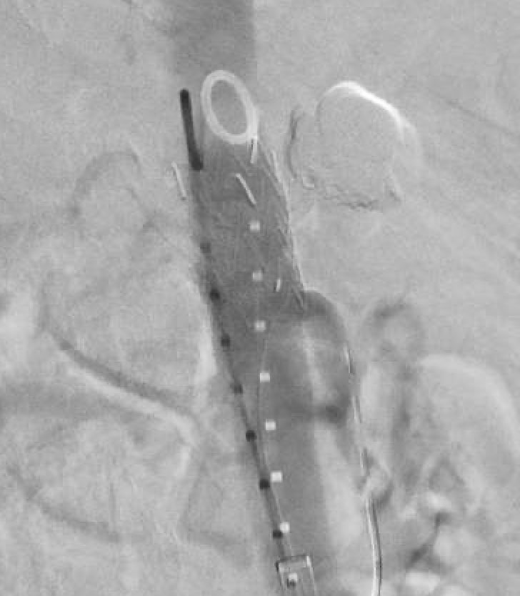 Bilateral groin access, catheterize the pseudo-aneurysm with a microcatheter, body 0.018 wire into the SMA (to mark it and maintain access), deploy aortic stent graft &gt; sac still opacified &gt; glue the sac entirely &gt; no sac filling! Strong work <a href="/MattScheidtVIR/">Matt Scheidt</a> <a href="/MCW_VIR/">MCW VIR</a> #IRad