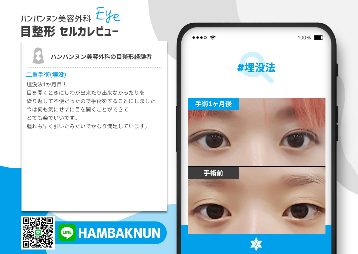 hambacnun's tweet photo. 元から自分の目であるかのような自然な二重ライン完成!
本院で二重手術埋没法を受けられた患者様の
手術前後の姿です!
#韓国整形外科　#目整形前後 https://t.co/ctGZLvKMKQ