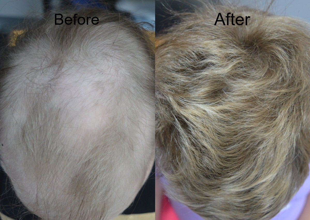 #JAKinhibitors such as #tofacitinib are revolutionising the treatment of #alopeciaareata 
Rewarding to be able to help patients with this distressing condition
@alopecia @AlopeciaUK @NAAF_org  @pfizer #alopecia #hairloss