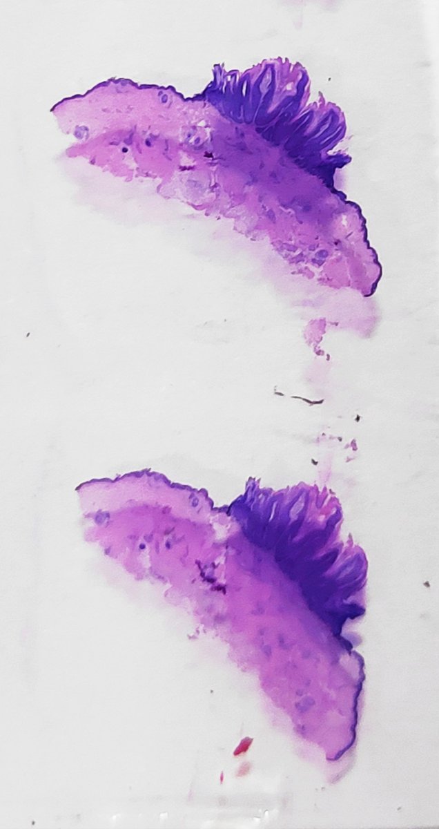 padmapathology1's tweet photo. #pathology #dermpath #grossmicrocorrelation Verruca vulgaris
*Finger like projections
*Hyperkeratosis and papillomatosis
*Tiers of parakeratosis
*Inward pointing elongated rete ridges
*koilocytes & coarse keratohyaline granules
*Regressing verrucae - nuclear changes not seen https://t.co/nNetpvNuuB