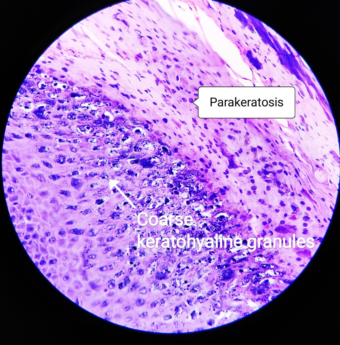 padmapathology1's tweet photo. #pathology #dermpath #grossmicrocorrelation Verruca vulgaris
*Finger like projections
*Hyperkeratosis and papillomatosis
*Tiers of parakeratosis
*Inward pointing elongated rete ridges
*koilocytes & coarse keratohyaline granules
*Regressing verrucae - nuclear changes not seen https://t.co/nNetpvNuuB