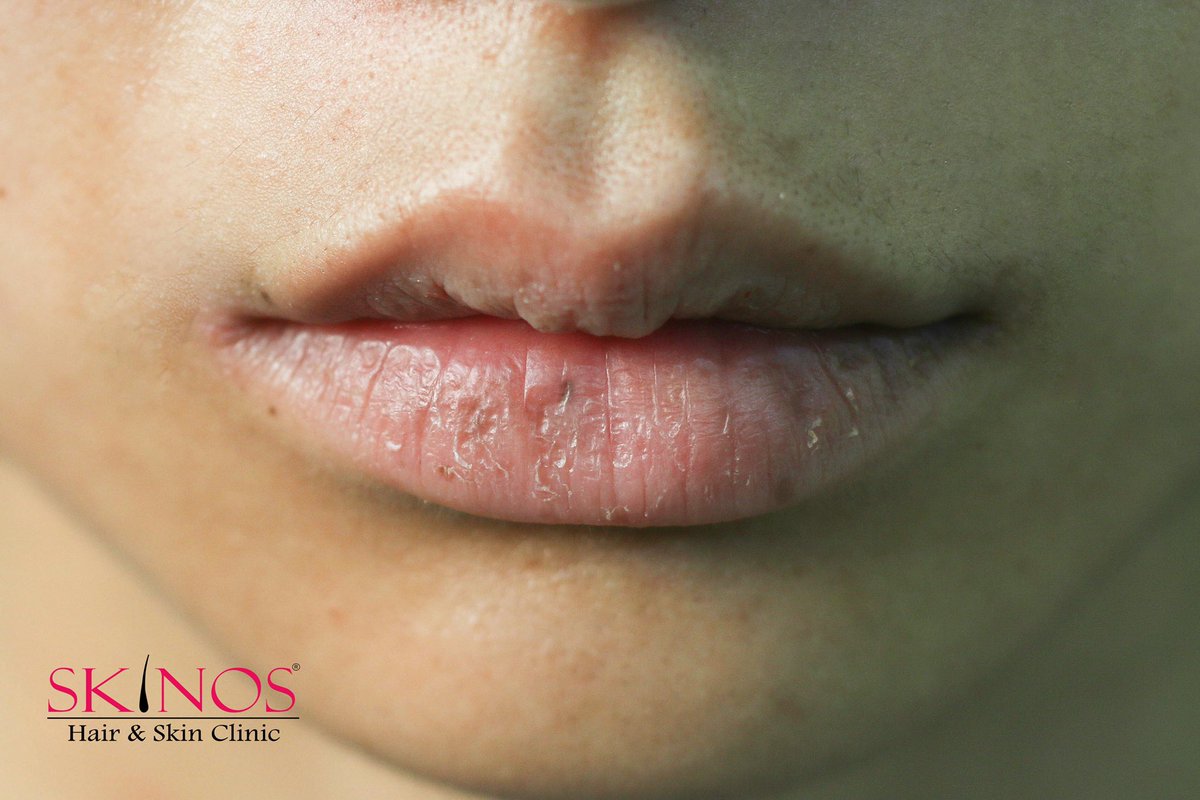 skinosclinic's tweet photo. Face is Index of mind and the lips are the most important part of the face! Hydrated, pink and full lips are signs of good health.
#DryLips #CrackedLips #PainfulLips #Lips #ChappedLips #BleedingLips #Skinos #Dermatologist #SkinSpecialist #DrShrutiGupta #DrSandeepKumar #Delhi https://t.co/5iAGvFlf1c