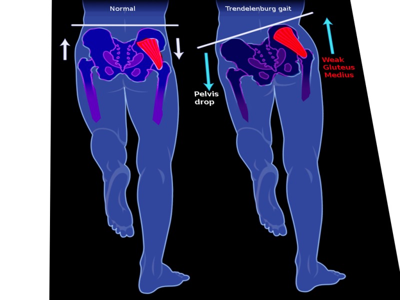 Ifumsaquizclub's tweet photo. BMS Wednesday📚🙋🏼🙋🏽
💥Trendelenburg's Sign
This is a physical examination finding associated with abnormalities of the Hip.
It occurs as a result of lesion to the superior gluteal nerve (L5–S2) that innervates the gluteus medius and minimus muscles.
#FebrileStuff🔥
#IQC https://t.co/i5eIDHXvZR